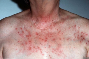 Az atópiás dermatitis - tünetek és kezelés, fotók, hogyan kell kezelni a neurodermitis