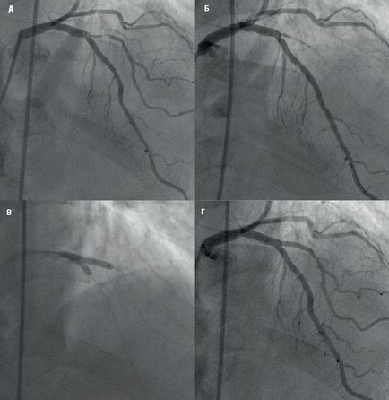 Új technikák elágazás stenting (stenting) Új technikák elágazás stenteléssel
