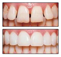 Нове слово в стоматології нано покриття зубів - ідеальне відбілювання з приголомшливим результатом!