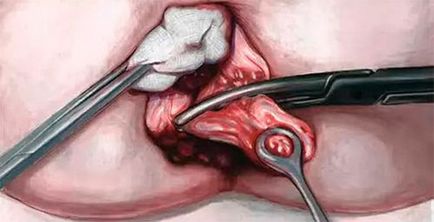 Operațiunea longo cu hemoroizi (hemoroidopexi)