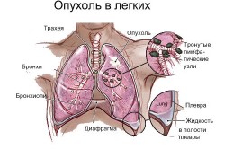 Funcționarea asupra plămânilor cu cancer