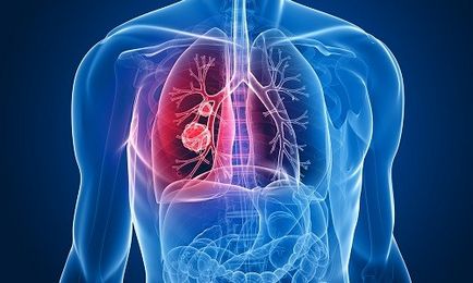 Операція на легенях при раку