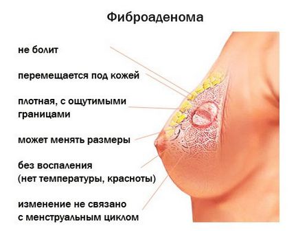 Tumora de sân la femei