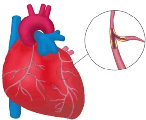 Myocardialis infarctus szövődményei