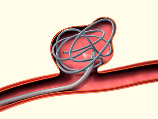 Основні методи лікування аневризм