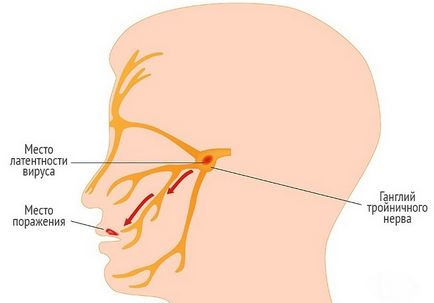 Simptomele principale ale herpes simplex