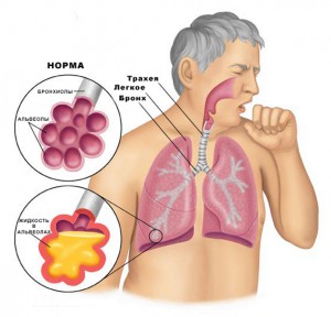 Expectorant împotriva tusei la rețete populare acasă și ierburi