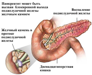 Tratamentul de pancreatită și simptomele, terapia și medicamentele ayurvedice