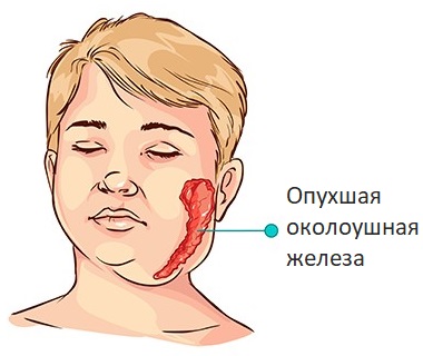 Паротит у дорослих симптоми, фото і лікування