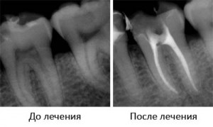Re-tratarea canalelor dentare, etapele de deschidere (înrădăcinare), tratamentul canalelor radiculare,