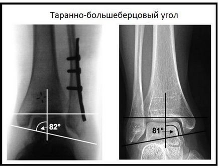 Fractură a gleznei, fotografie înainte și după, chirurgie, recenzii, tratament, reabilitare și recuperare