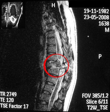 Fractura coloanei vertebrale