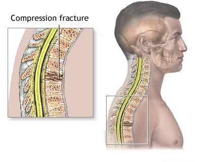 Fractura coloanei vertebrale