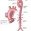 Perforarea esofagului - jurnal medical