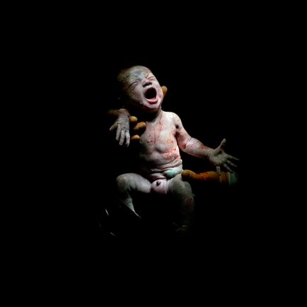 Перші секунди життя немовлят після кесаревого розтину - спірні фото
