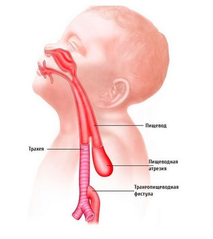 Fistula esofagiană-traheală cauzează, simptome și tratament