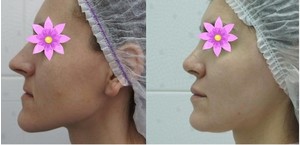 Chirurgie plastica de a face sau nu - femeie de zi