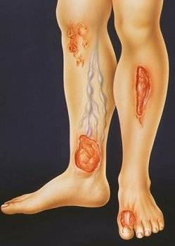 Чому з'являються трофічні виразки на ногах, їх симптоми і способи лікування