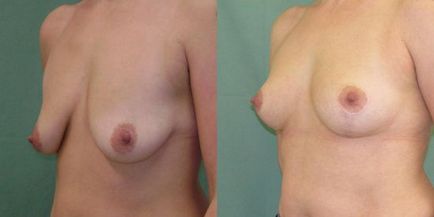 Ridicarea sânilor (mastopexie), liftingul sânilor - prețul, fotografie înainte și după ridicare, revizuiește acest lucru