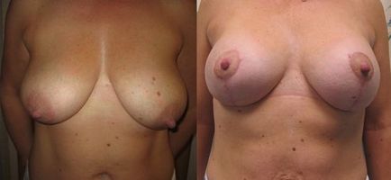 Ridicarea sânilor (mastopexie), liftingul sânilor - prețul, fotografie înainte și după ridicare, revizuiește acest lucru