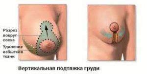 Підтяжка грудних залоз без імплантів ціна і фото до і після