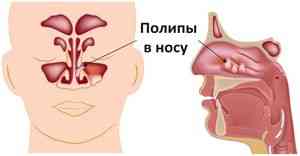 Polipi în tratamentul nasului cu remedii folclorice - boli alergice - catalog de articole - folk