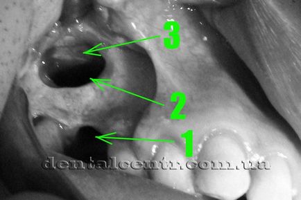 Implantarea implantului dentar