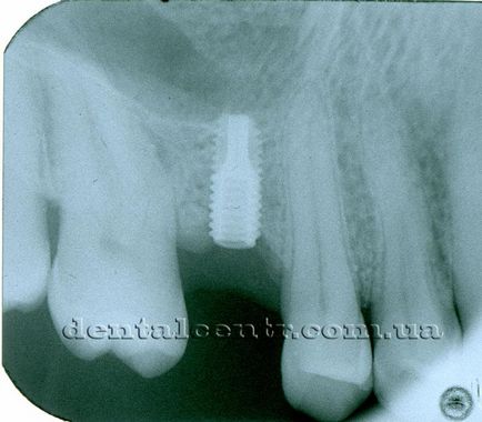 Implantarea implantului dentar