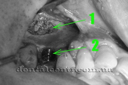 Implantarea implantului dentar