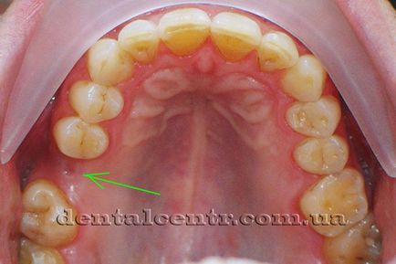 Implantarea implantului dentar