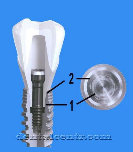 Implantarea implantului dentar