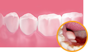 Після видалення зуба стирчить кістка з ясен (оголилася окістя) що робити