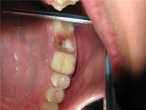 După extragerea dintelui, osul din gingie se stinge (periostul a expus) ce să facă