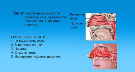 Constant nasul înfundat, dar nici nasul și mucoasa - principalele motive