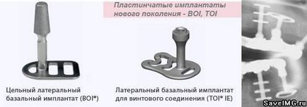 Правда і вигадка про базальної імплантації зубів, відгуки хто робив