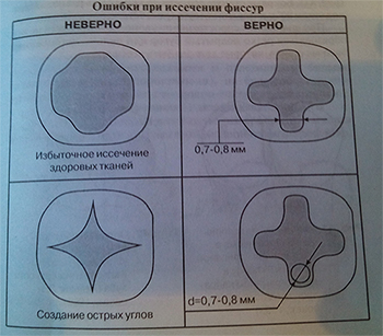 Disecția cariilor carioase