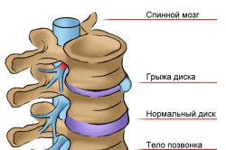 Cauze ale herniei intervertebrale