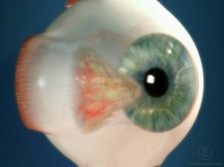 Pterygium, fotó és leírás pterygium, jelek, tünetek, kezelés