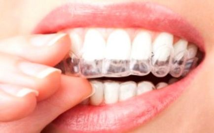 Рекомендації щодо застосування та відгуки про капах для відбілювання зубів