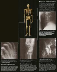 Radiografii în diagnosticul de fracturi și dislocări ale oaselor (cunoștințe - diagnoză)