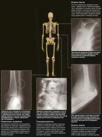 Radiografii în diagnosticul de fracturi și dislocări ale oaselor (cunoștințe - diagnoză)