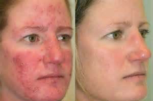 Rosacea, acne rosacea, acne pink - kezelés, a beteg tünetei, megelőzése, okai