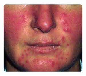 Rosaceea, rosaceea, tratamentul cu acnee roz, simptomele și manifestările, prevenirea, cauzele