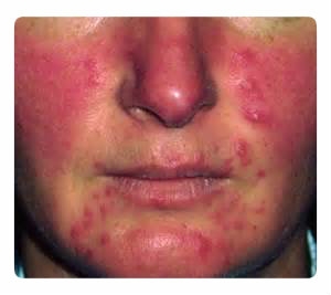 Rosacea, acne rosacea, acne pink - kezelés, a beteg tünetei, megelőzése, okai