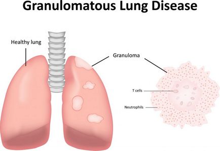 Sarcoidoza simptomelor, cauzelor, diagnosticului și tratamentului plămânilor