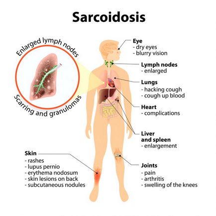 Sarcoidoza simptomelor, cauzelor, diagnosticului și tratamentului plămânilor