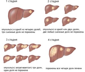 Саркома печінки симптоми, діагностика і сучасне лікування