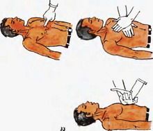 Reacția cardiopulmonară respiratorie artificială și masajul cardiac, în primul rând medicale