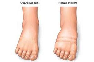 Сильний набряк ніг, причини, симптоми, як зняти набряки з ніг