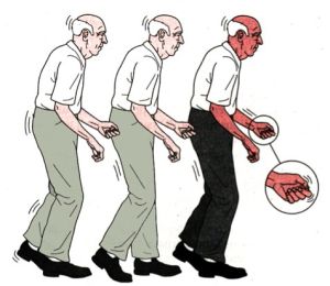Sindromul de instabilitate posturală în bolile Parkinson și SNC